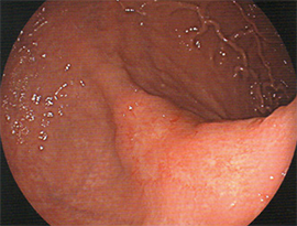 胃カメラの検査画像02
