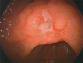胃カメラの検査画像03